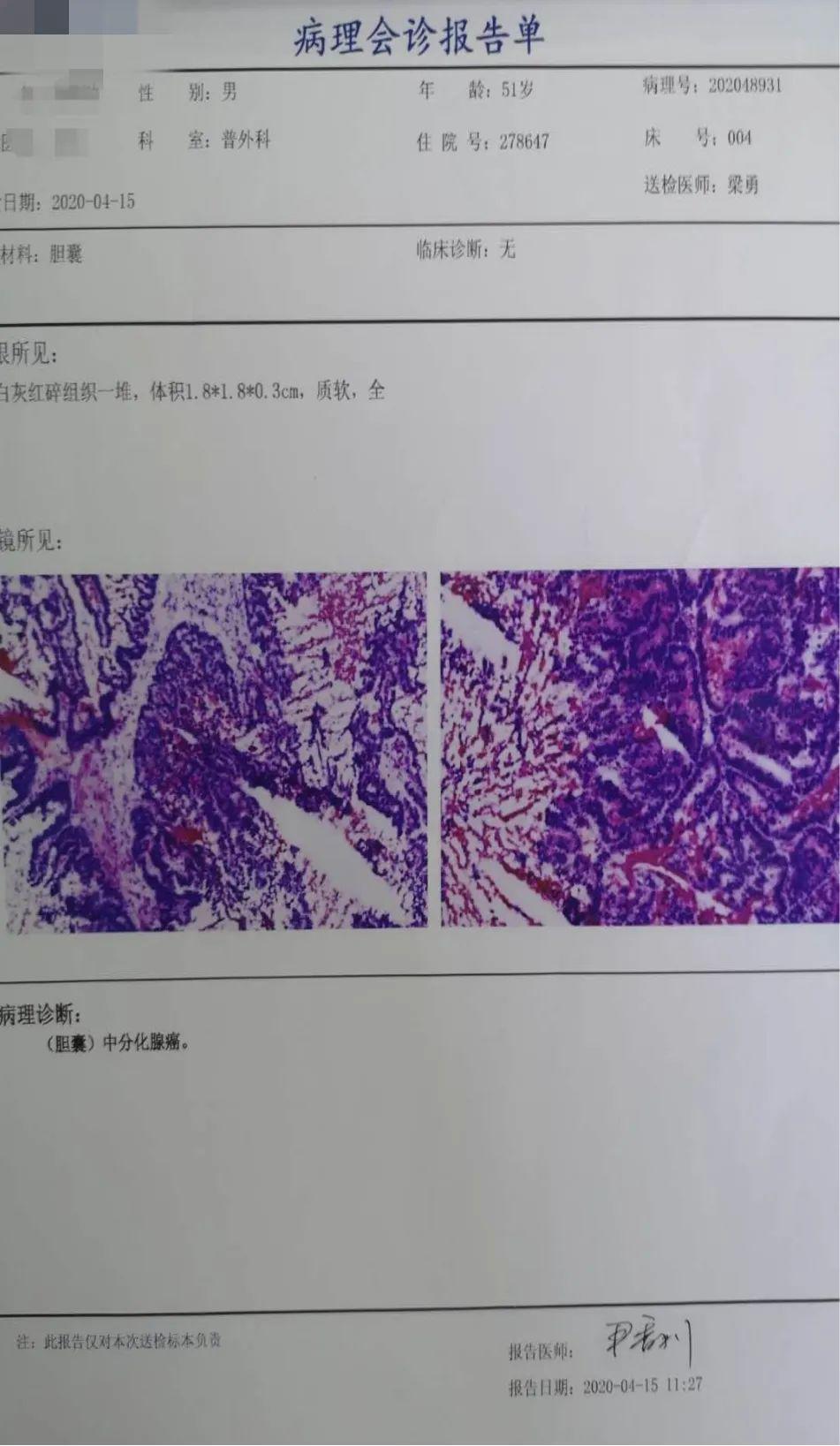 腔镜再谱新华章普外微创巧除瘤