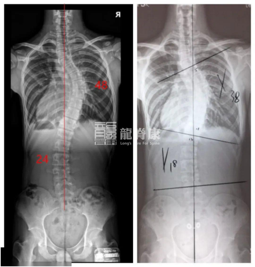 病例18岁的48侧弯男孩半年内度数减少了10