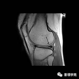 下图为内侧半月板后角内稍高信号未及关节面(ii 级) Ⅲ 级:半月板内