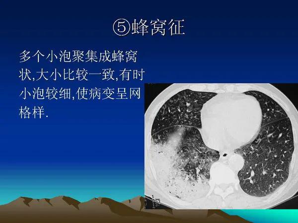 肺泡性肺癌影像学表现