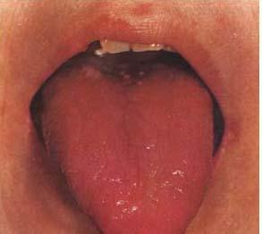 多为肝郁气滞,气虚所致. 3,血虚: 舌苔淡白色,整体舌色淡白.