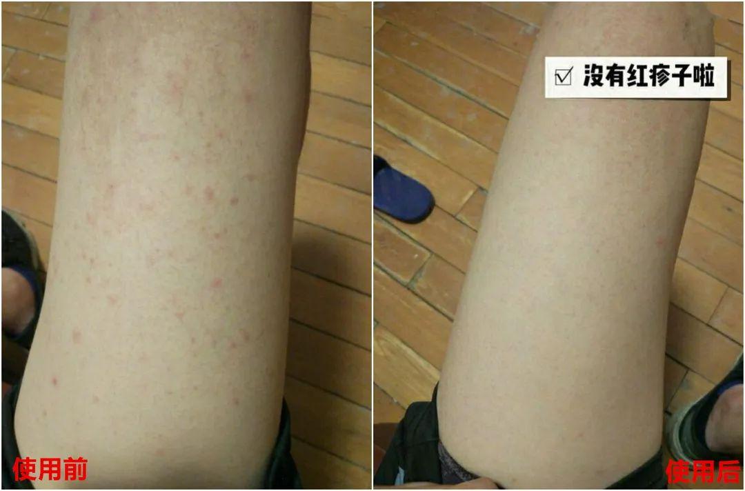 针对金黄色葡萄球菌,白念珠菌引发的一系列 皮炎,脚癣等问题,有很好的