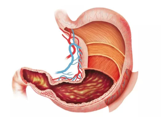 贲门癌现在又被称为胃食管结合部癌(esophagogastric junction