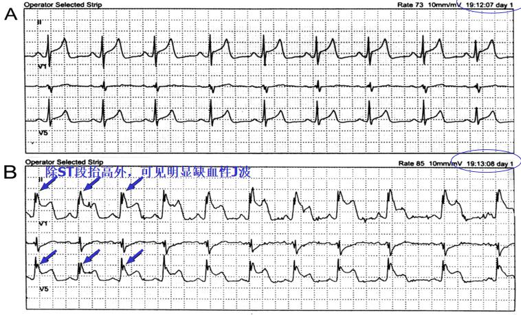 临床必备猝死预警心电图分析