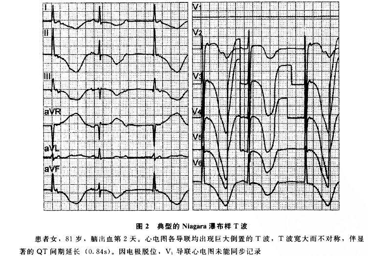 dolana等又发现ront现象室性早搏可以诱发室性心动过速或心室颤动.