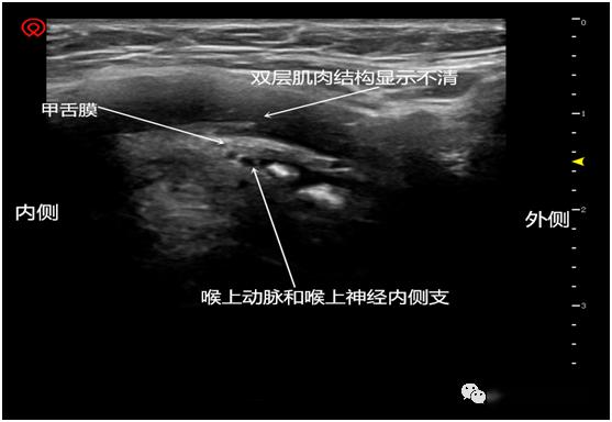 超声专题超声引导喉上神经阻滞的临床实战思维