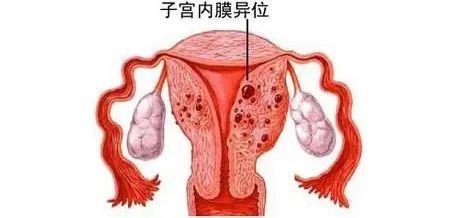 如先天性生殖道畸形,继发性宫颈粘连等