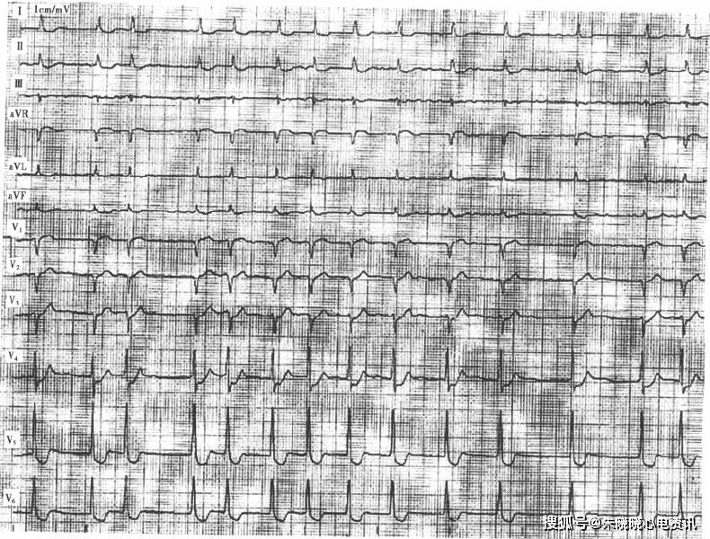 心电图可见qt间期缩短,st段下斜型压低,t波双向,双支不对称,前支陡直
