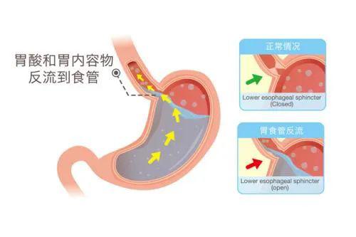 食管反流病不止是反酸烧心这几大症状需警惕