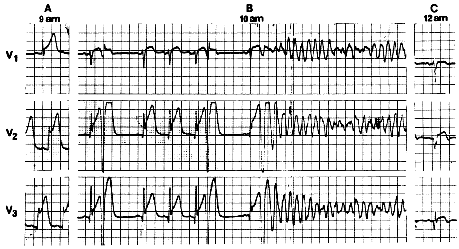 心室易颤期位于心室收缩中期末尾,相当于心电图上t波顶峰前30ms及t波