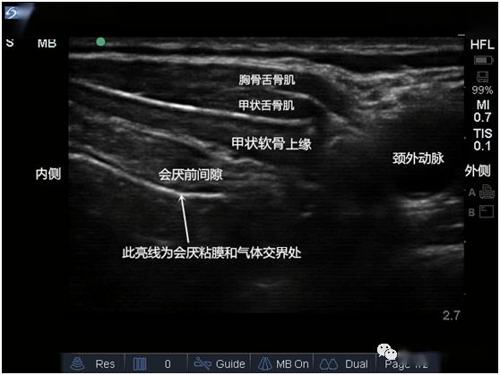 超声专题超声引导喉上神经阻滞的临床实战思维