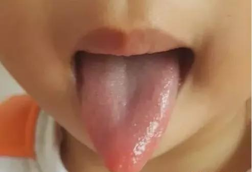 『孩子』肝气不舒，脾气大？小儿推拿来调理捏积派——孩子舌头尖尖