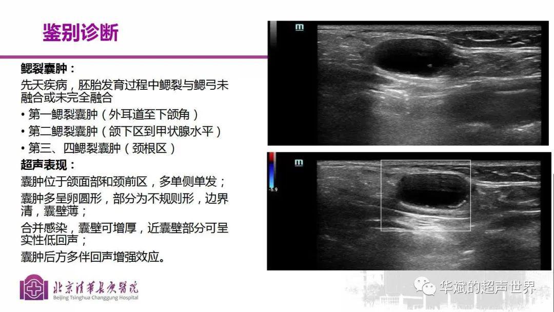 文献学习与病例:颈部支气管源性囊肿的超声表现