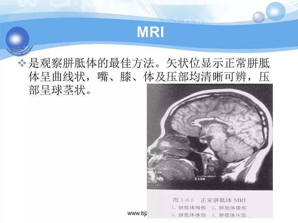 胼胝体发育不良的影像诊断