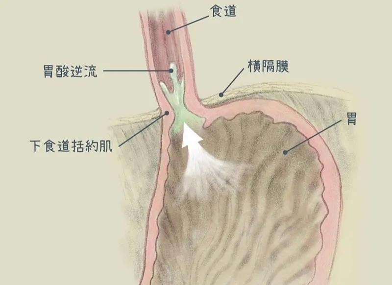 胃与食道交界处有一肌肉结构为「下食道括约肌」,若下食道括约肌不