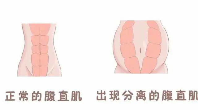 孕晚期,增大的子宫会将腹肌拉长,使两条腹直肌从腹白线的位置分开