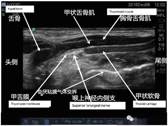 超声专题超声引导喉上神经阻滞的临床实战思维