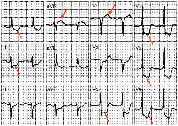 临床必备猝死预警心电图分析