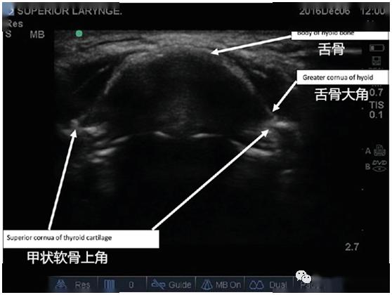 超声专题超声引导喉上神经阻滞的临床实战思维