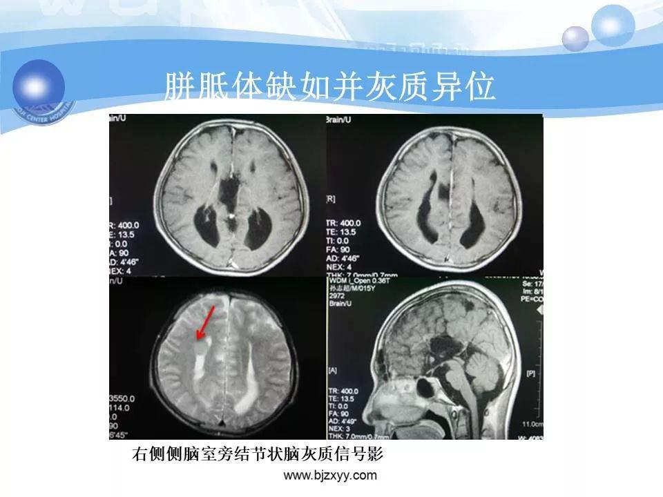 胼胝体发育不良的影像诊断