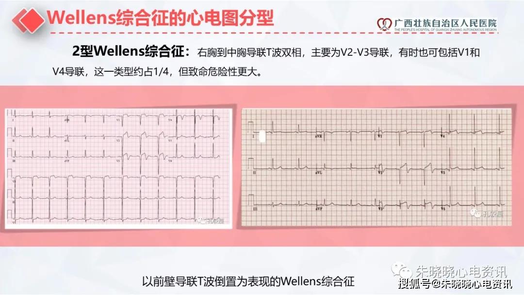 dewinter综合征与wellens综合征张雅莉广西自治区人民医院