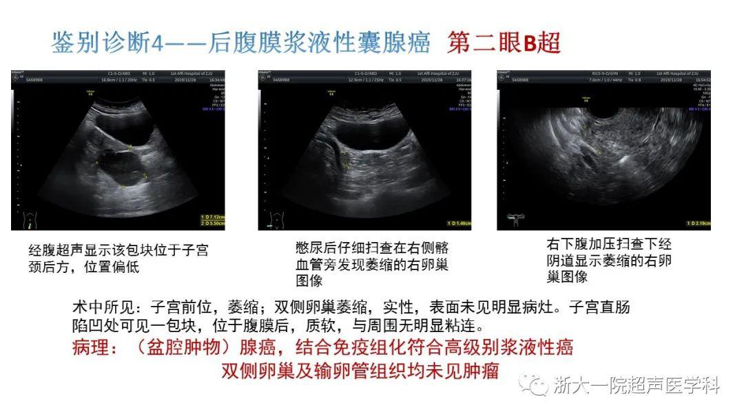 探囊取"悟"——卵巢囊腺瘤的超声诊断