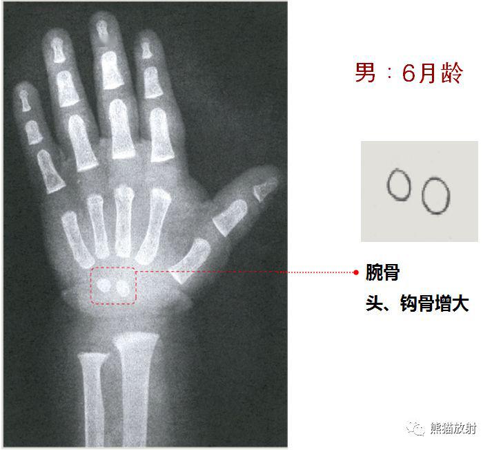 收藏丨骨龄图谱方便随时对照