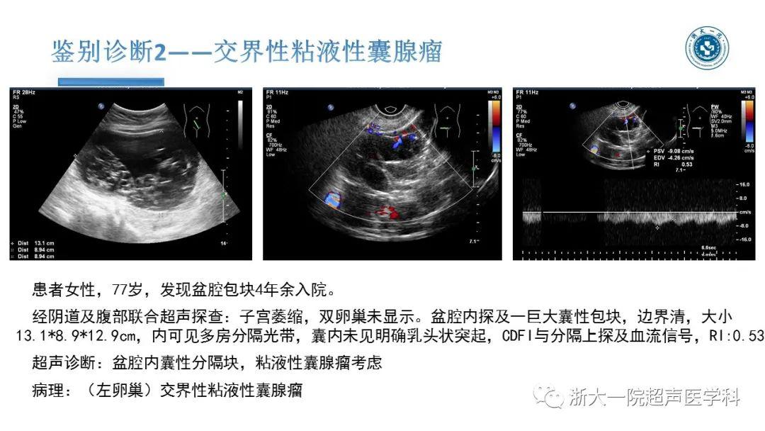 探囊取"悟"——卵巢囊腺瘤的超声诊断