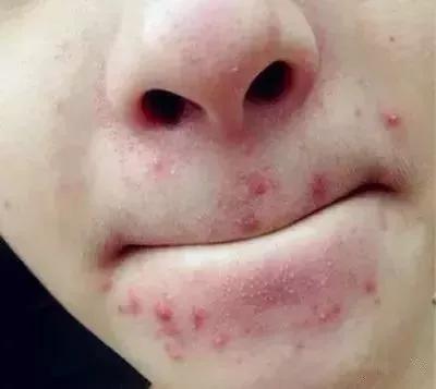 嘴巴周围长痘痘是什么原因引起的 该如何调理
