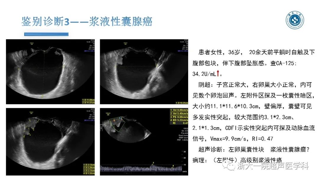 探囊取悟卵巢囊腺瘤的超声诊断