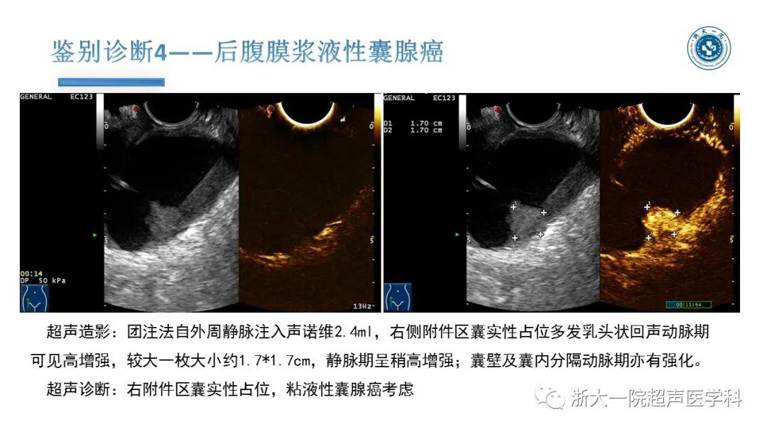 探囊取悟卵巢囊腺瘤的超声诊断