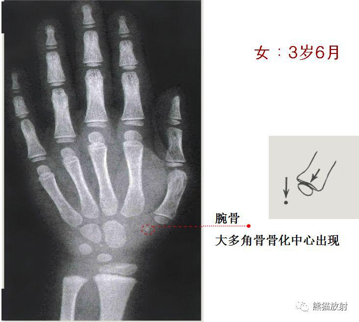 收藏丨骨龄图谱方便随时对照