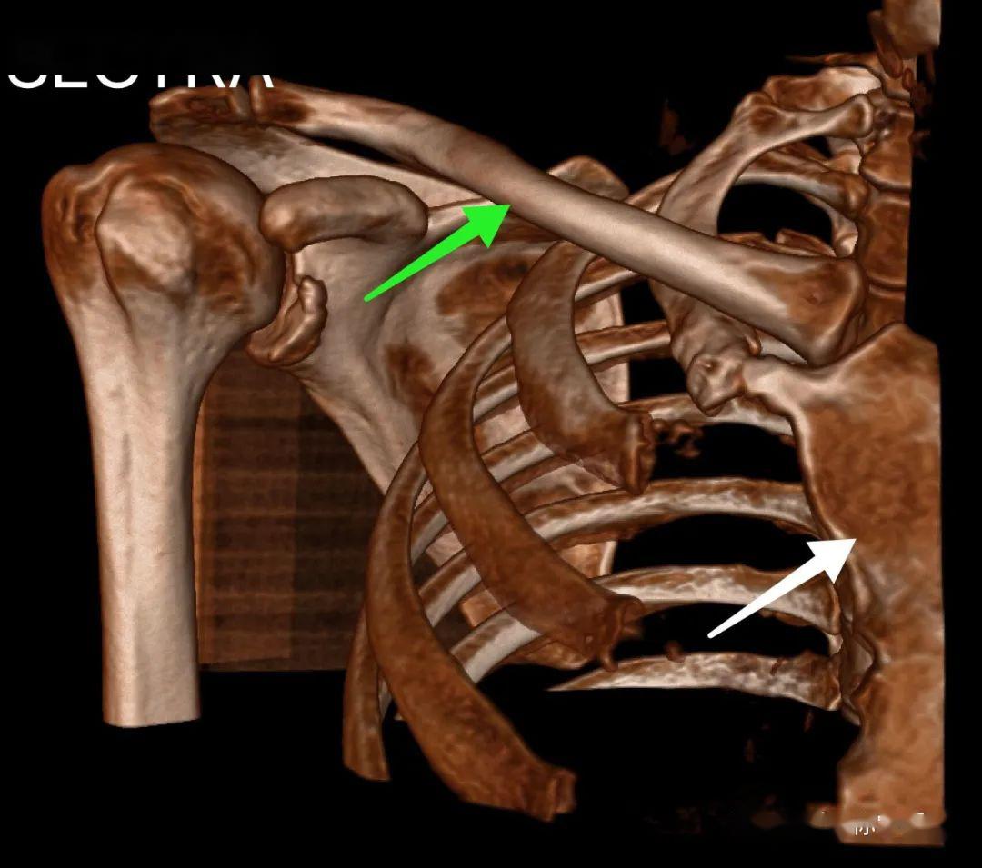后方有两块肩胛骨 胸锁关节连接胸骨和两侧锁骨. 绿色:胸锁关节