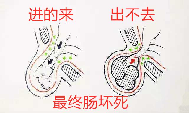 及时用手法按压还纳使其回到腹腔,避免发生疝气卡住,进一步发生肠坏死