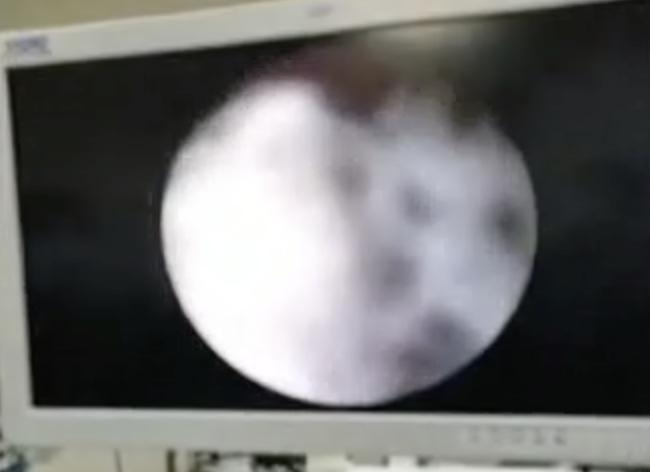 「孩子」还有异味！母亲怀疑性早熟，原因竟是…两岁女童下体间断性出血