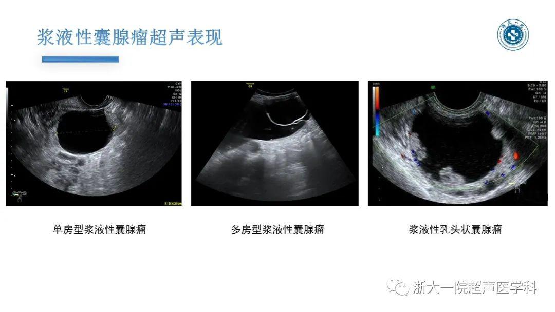 探囊取"悟"——卵巢囊腺瘤的超声诊断