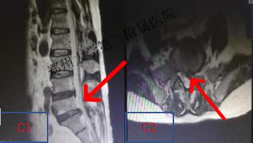 图c1,c2为术前腰椎mri关联图像:腰5/骶1椎间盘向左后方突出,压迫左侧