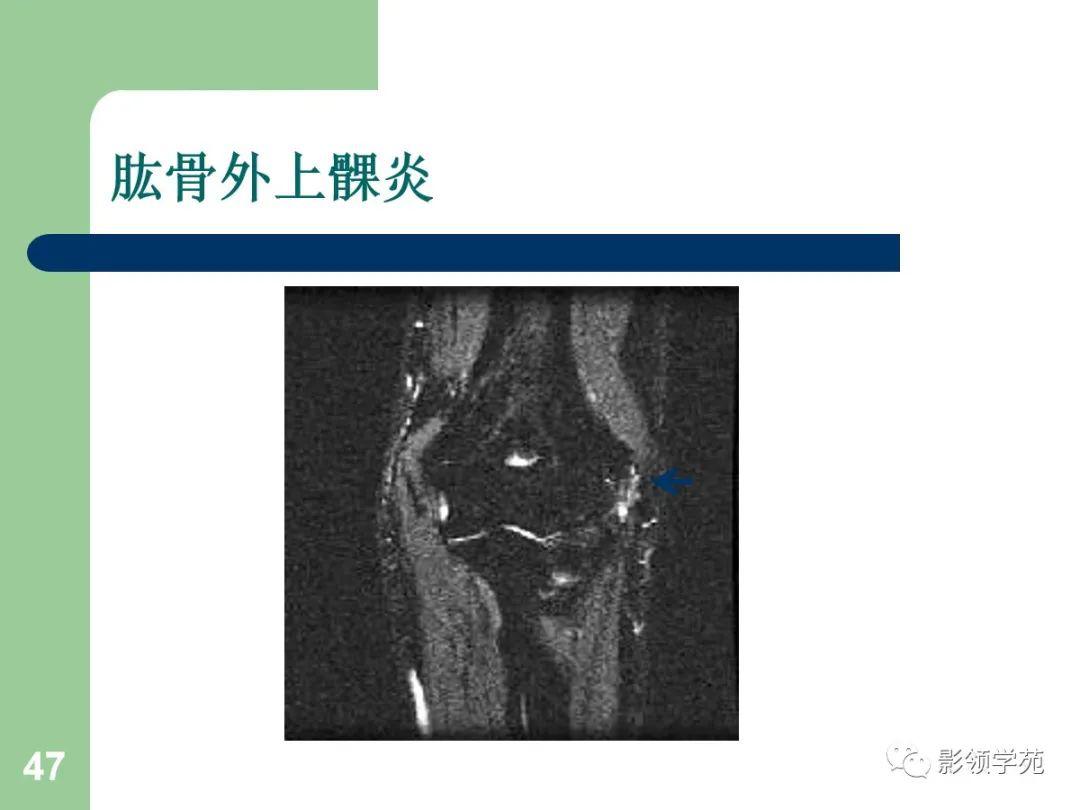 肘关节mri临床应用