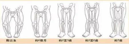 1岁宝宝o型腿怎么办