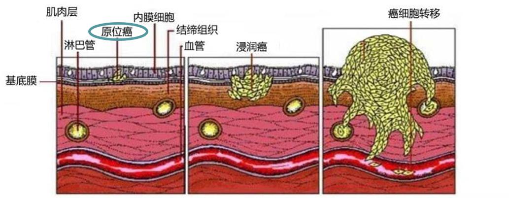 毕竟,原位癌是属于恶性细胞局限于上皮内尚未穿破基底膜浸润周围正常