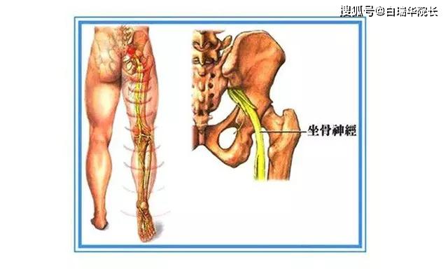 如何避免坐骨神经痛