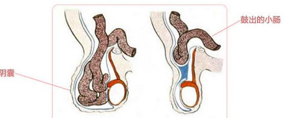 热血外科 | dr.liu聊科普之疝气