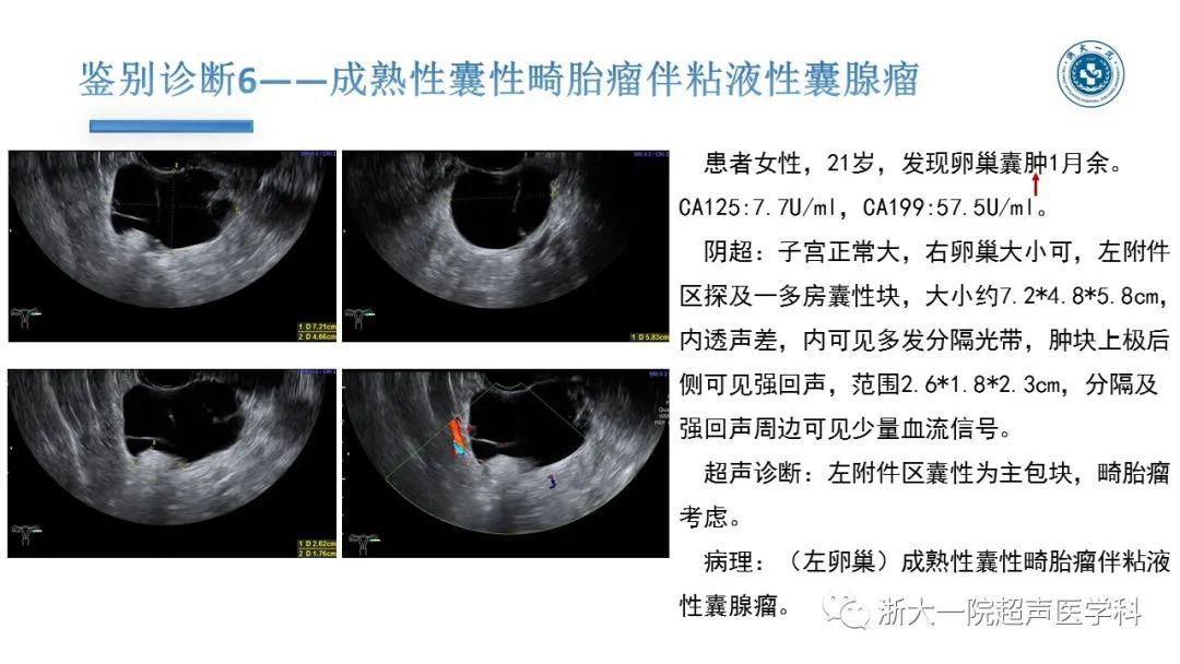 探囊取悟卵巢囊腺瘤的超声诊断