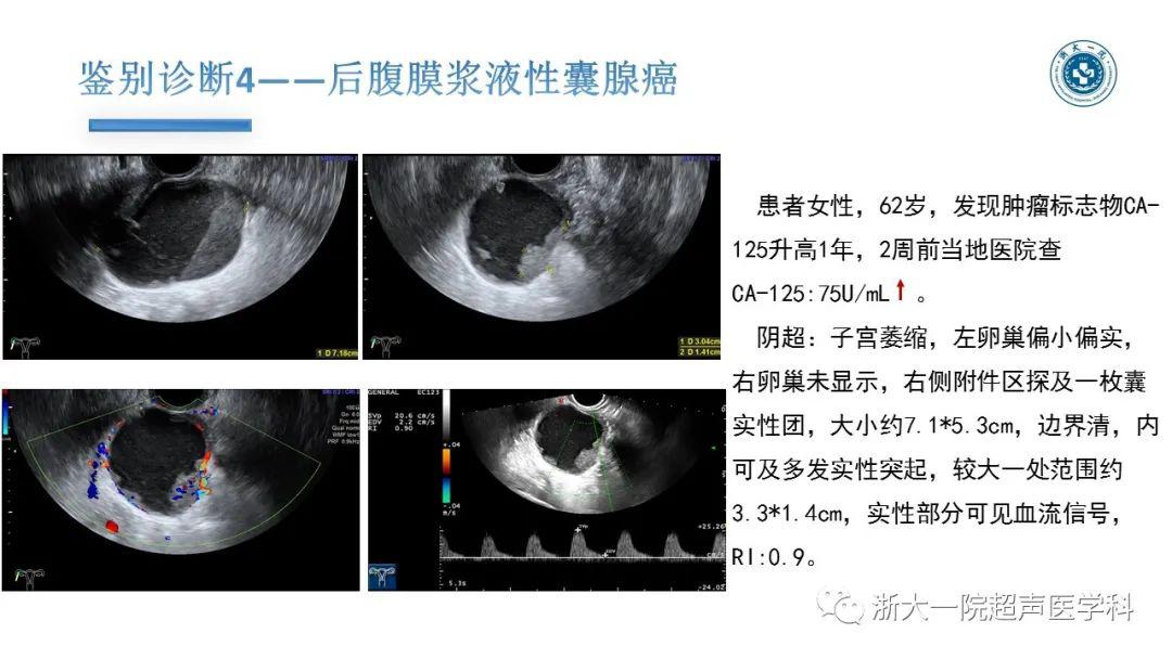 探囊取"悟"——卵巢囊腺瘤的超声诊断