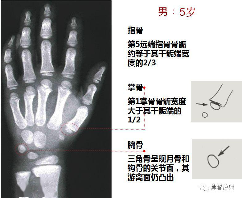 收藏丨骨龄图谱方便随时对照