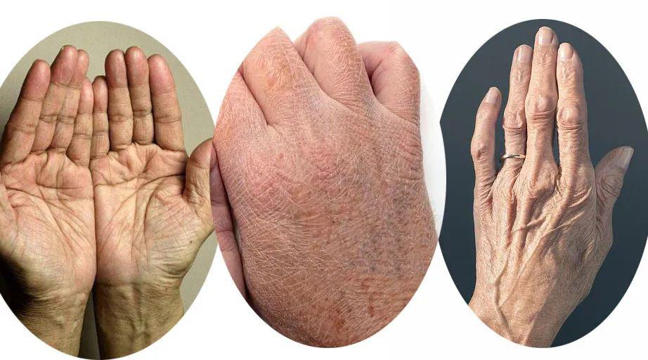 长期用含碱类会使手部皮肤迅速老化开裂!