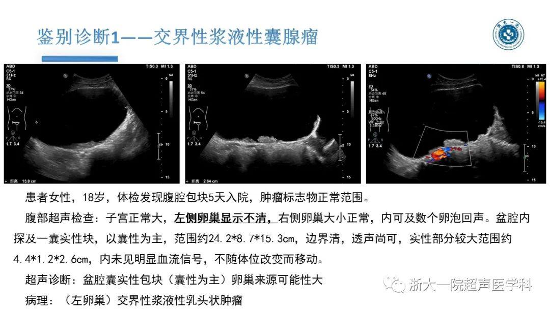 探囊取"悟"——卵巢囊腺瘤的超声诊断