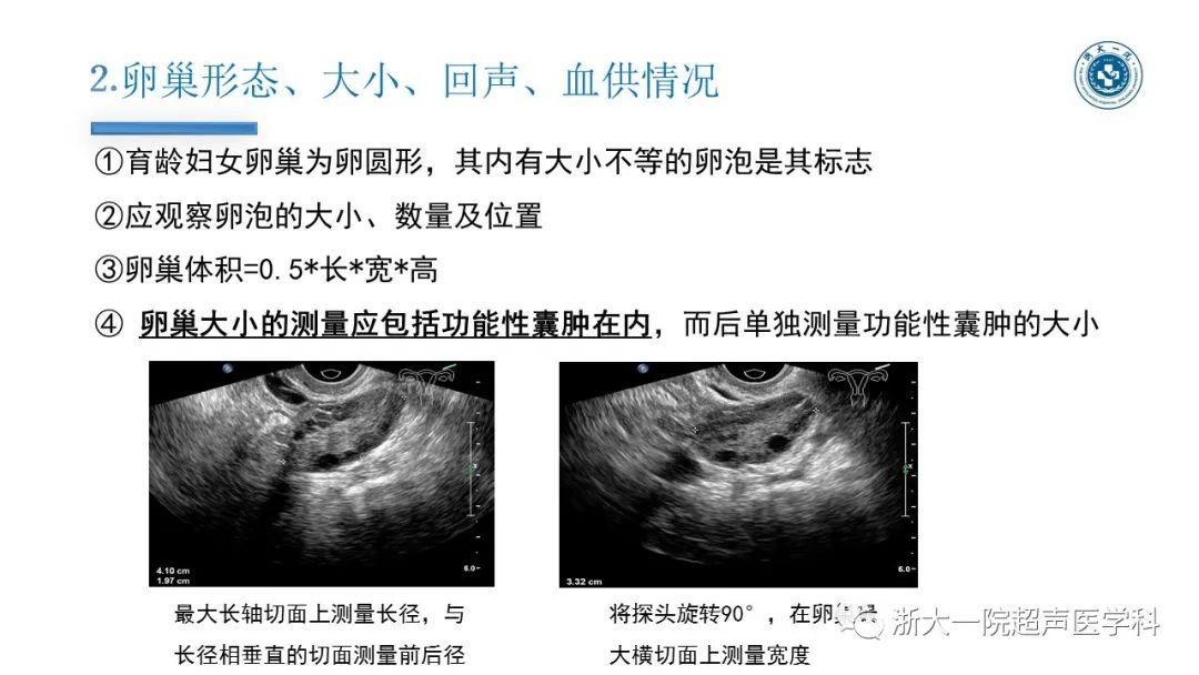 探囊取"悟"——卵巢囊腺瘤的超声诊断