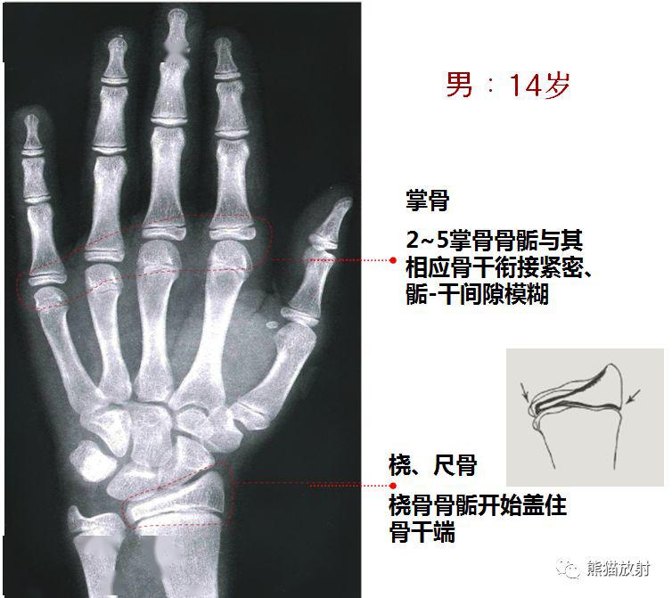 收藏丨骨龄图谱!(方便随时对照)