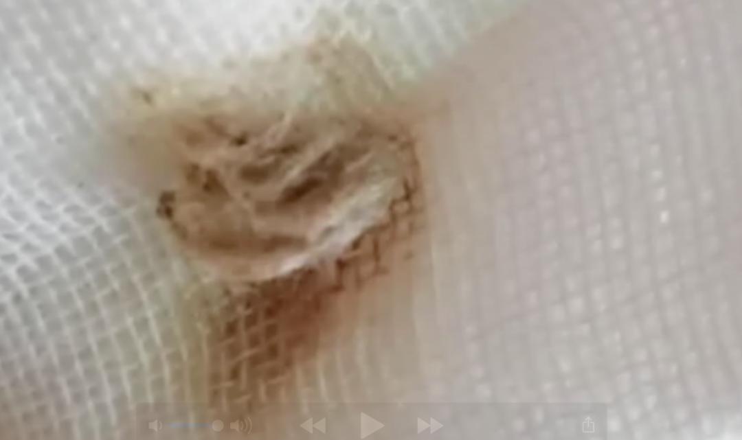 「孩子」还有异味！母亲怀疑性早熟，原因竟是…两岁女童下体间断性出血